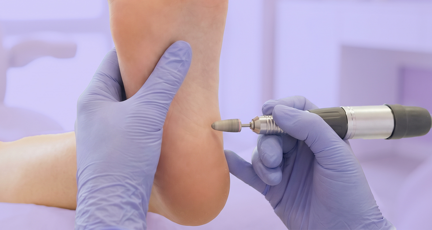 Callus Treatment