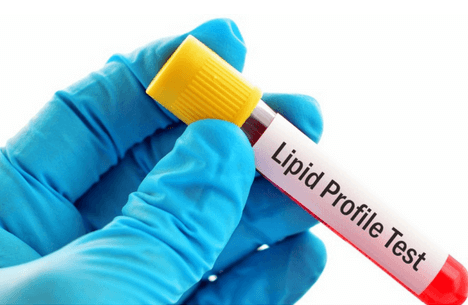 Lipid / Cholesterol Profile